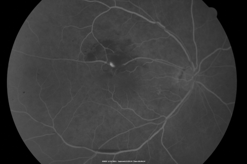 Retinal Arterial Macroaneurysm - Increased Swelling after Laser 
65-year-old woman was seen in the office on January 12, 2011.   She has noticed decreased vision in the right eye for the last two or three weeks.  She has had some discomfort in both eyes as well.  She has a history of low blood pressure, but she does have high cholesterol.  

VISUAL ACUITY:  OD 20/60
