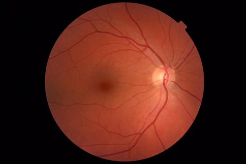 Melanocytoma - Lightly Pigmented
42 year old female with very mild visual field and vision loss in the left eye: 20/20 OU
