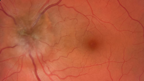 Melanocytoma - Lightly Pigmented
42 year old female with very mild visual field and vision loss in the left eye: 20/20 OU
