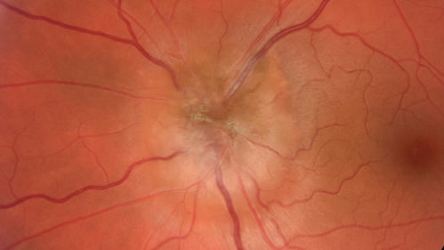 Melanocytoma - Lightly Pigmented
42 year old female with very mild visual field and vision loss in the left eye: 20/20 OU
