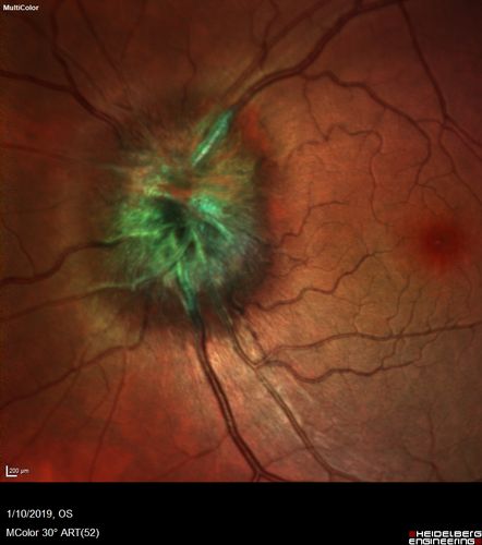 Melanocytoma - Lightly Pigmented
42 year old female with very mild visual field and vision loss in the left eye: 20/20 OU
