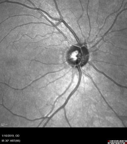 Melanocytoma - Lightly Pigmented
42 year old female with very mild visual field and vision loss in the left eye: 20/20 OU
