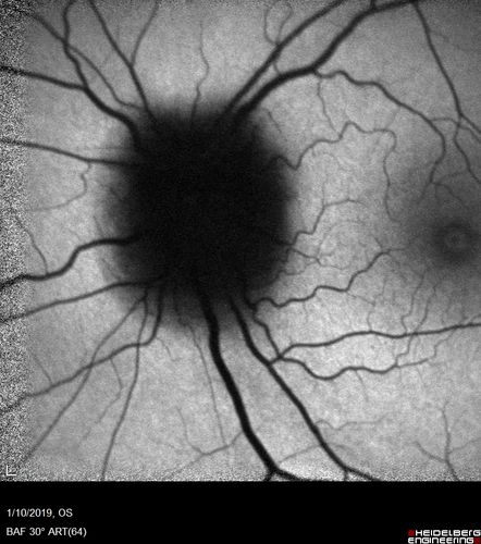 Melanocytoma - Lightly Pigmented
42 year old female with very mild visual field and vision loss in the left eye: 20/20 OU
