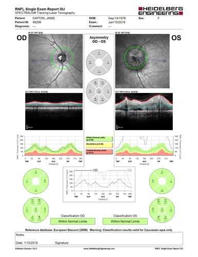 Melanocytoma - Lightly Pigmented
42 year old female with very mild visual field and vision loss in the left eye: 20/20 OU
