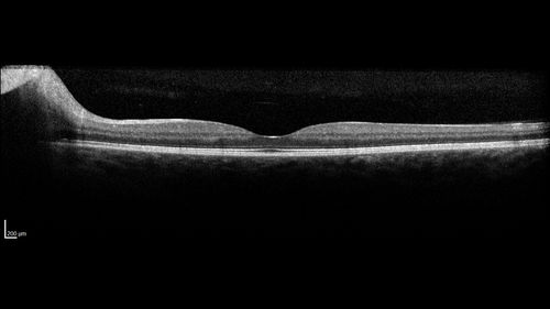 Melanocytoma - Lightly Pigmented
42 year old female with very mild visual field and vision loss in the left eye: 20/20 OU
