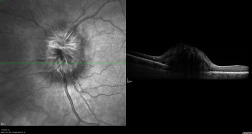 Melanocytoma - Lightly Pigmented
42 year old female with very mild visual field and vision loss in the left eye: 20/20 OU

