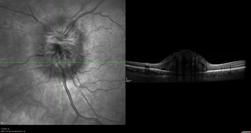 Melanocytoma - Lightly Pigmented
42 year old female with very mild visual field and vision loss in the left eye: 20/20 OU
