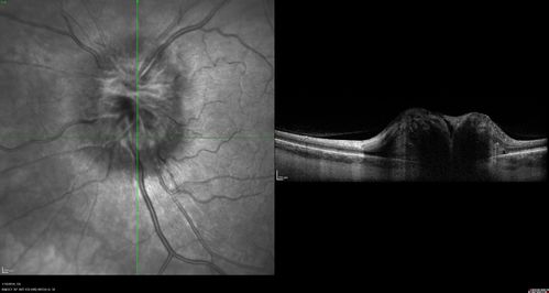 Melanocytoma - Lightly Pigmented
42 year old female with very mild visual field and vision loss in the left eye: 20/20 OU
