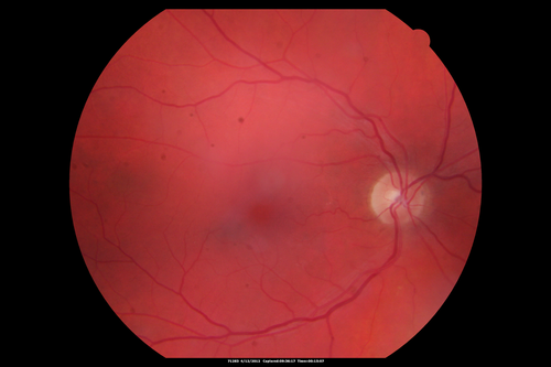Medium Choroidal Melanoma Left Eye 
