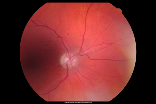 Medium Choroidal Melanoma Left Eye 
