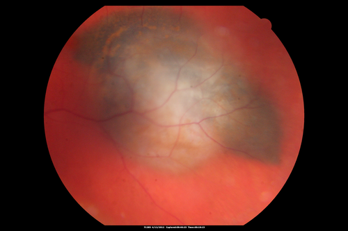 Medium Choroidal Melanoma Left Eye 
