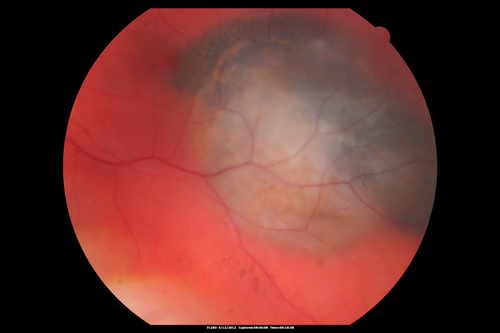 Medium Choroidal Melanoma Left Eye 
