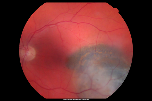 Medium Choroidal Melanoma Left Eye 
