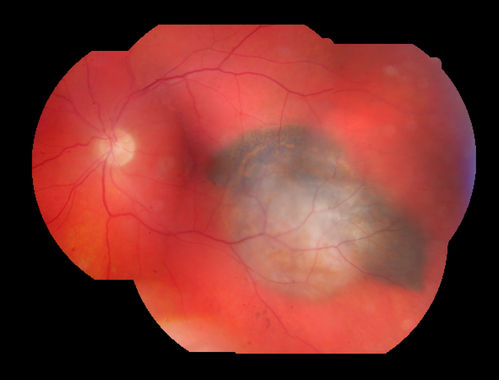 Medium Choroidal Melanoma Left Eye 
