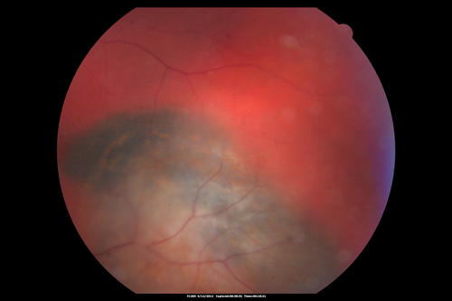 Medium Choroidal Melanoma Left Eye 
