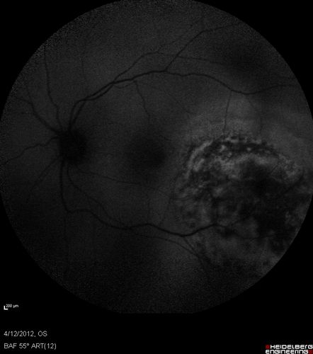 Medium Choroidal Melanoma Left Eye 
