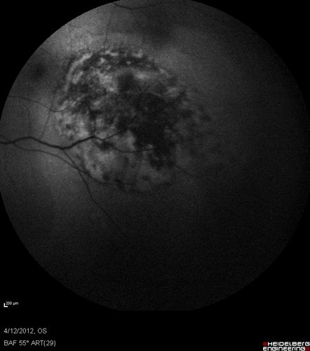 Medium Choroidal Melanoma Left Eye 
