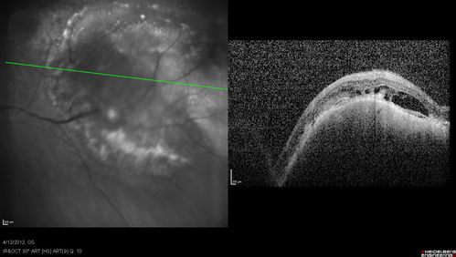 Medium Choroidal Melanoma Left Eye 
