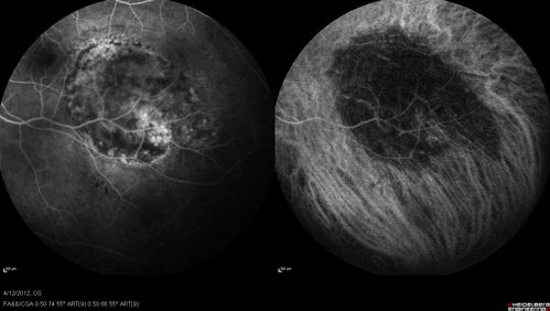 Medium Choroidal Melanoma Left Eye 
