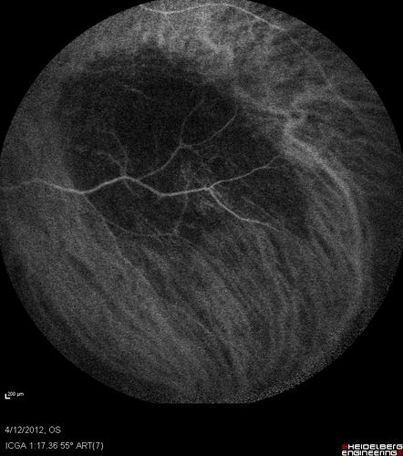 Medium Choroidal Melanoma Left Eye 
