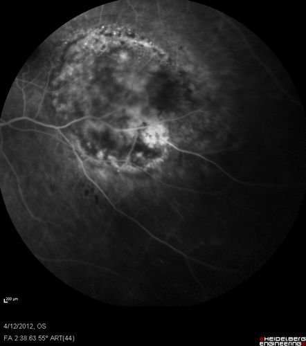 Medium Choroidal Melanoma Left Eye 
