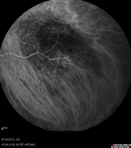Medium Choroidal Melanoma Left Eye 
