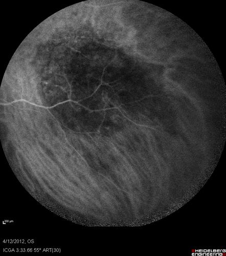 Medium Choroidal Melanoma Left Eye 
