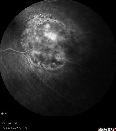 Medium Choroidal Melanoma Left Eye 

