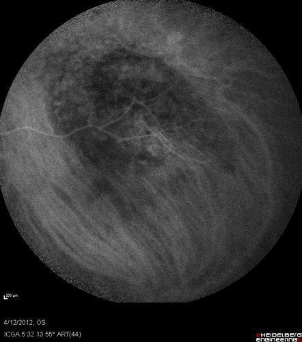 Medium Choroidal Melanoma Left Eye 
