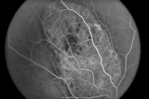 Choroidal Melanoma Medium
33-year-old man with a history of decreased in the right eye.  He had blurring in the eye about a year ago.  He reports that it improved spontaneously until it was â€œnearly resolvedâ€.  He said he had some persistent distortion, but that over the past couple of weeks he has noticed this dark spot recurring in the right eye, the left eye is unaffected.  He does not have any flashes, floaters or change in his peripheral visual acuity.   20/80 OD, 20/16 OS.  No improvement with pinhole.  IOP: 12 OD, 11 OS.  

POSTERIOR SEGMENT EXAMINATION: Shows a clear view with no PVD in either eye.  C/D ratio is 0.2 OU.  Large retinal vessels are unremarkable.  The macula of the right eye has a brown choroidal lesion with pigment overlying the surface and orange spots along its lateral surface.  The left macula is normal.  
B-SCAN:  B-scan ecography of the ultrasound of the right eye shows a mass about 5 mm high with a moderate to low internal reflectivity on A-scan echogram.  There is serous fluid inferiorly on the echogram
