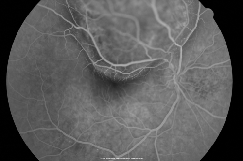 Choroidal Melanoma Medium
33-year-old man with a history of decreased in the right eye.  He had blurring in the eye about a year ago.  He reports that it improved spontaneously until it was â€œnearly resolvedâ€.  He said he had some persistent distortion, but that over the past couple of weeks he has noticed this dark spot recurring in the right eye, the left eye is unaffected.  He does not have any flashes, floaters or change in his peripheral visual acuity.   20/80 OD, 20/16 OS.  No improvement with pinhole.  IOP: 12 OD, 11 OS.  

POSTERIOR SEGMENT EXAMINATION: Shows a clear view with no PVD in either eye.  C/D ratio is 0.2 OU.  Large retinal vessels are unremarkable.  The macula of the right eye has a brown choroidal lesion with pigment overlying the surface and orange spots along its lateral surface.  The left macula is normal.  
B-SCAN:  B-scan ecography of the ultrasound of the right eye shows a mass about 5 mm high with a moderate to low internal reflectivity on A-scan echogram.  There is serous fluid inferiorly on the echogram
