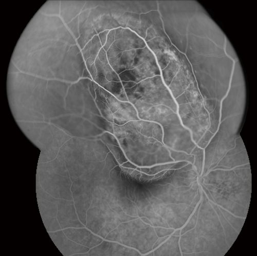Choroidal Melanoma Medium
33-year-old man with a history of decreased in the right eye.  He had blurring in the eye about a year ago.  He reports that it improved spontaneously until it was â€œnearly resolvedâ€.  He said he had some persistent distortion, but that over the past couple of weeks he has noticed this dark spot recurring in the right eye, the left eye is unaffected.  He does not have any flashes, floaters or change in his peripheral visual acuity.   20/80 OD, 20/16 OS.  No improvement with pinhole.  IOP: 12 OD, 11 OS.  

POSTERIOR SEGMENT EXAMINATION: Shows a clear view with no PVD in either eye.  C/D ratio is 0.2 OU.  Large retinal vessels are unremarkable.  The macula of the right eye has a brown choroidal lesion with pigment overlying the surface and orange spots along its lateral surface.  The left macula is normal.  
B-SCAN:  B-scan ecography of the ultrasound of the right eye shows a mass about 5 mm high with a moderate to low internal reflectivity on A-scan echogram.  There is serous fluid inferiorly on the echogram
