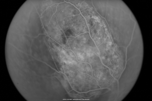 Choroidal Melanoma Medium
33-year-old man with a history of decreased in the right eye.  He had blurring in the eye about a year ago.  He reports that it improved spontaneously until it was â€œnearly resolvedâ€.  He said he had some persistent distortion, but that over the past couple of weeks he has noticed this dark spot recurring in the right eye, the left eye is unaffected.  He does not have any flashes, floaters or change in his peripheral visual acuity.   20/80 OD, 20/16 OS.  No improvement with pinhole.  IOP: 12 OD, 11 OS.  

POSTERIOR SEGMENT EXAMINATION: Shows a clear view with no PVD in either eye.  C/D ratio is 0.2 OU.  Large retinal vessels are unremarkable.  The macula of the right eye has a brown choroidal lesion with pigment overlying the surface and orange spots along its lateral surface.  The left macula is normal.  
B-SCAN:  B-scan ecography of the ultrasound of the right eye shows a mass about 5 mm high with a moderate to low internal reflectivity on A-scan echogram.  There is serous fluid inferiorly on the echogram
