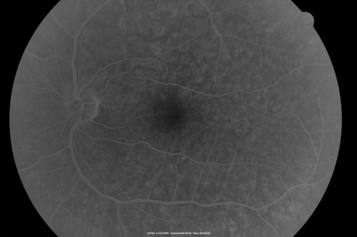 Choroidal Melanoma Medium
33-year-old man with a history of decreased in the right eye.  He had blurring in the eye about a year ago.  He reports that it improved spontaneously until it was â€œnearly resolvedâ€.  He said he had some persistent distortion, but that over the past couple of weeks he has noticed this dark spot recurring in the right eye, the left eye is unaffected.  He does not have any flashes, floaters or change in his peripheral visual acuity.   20/80 OD, 20/16 OS.  No improvement with pinhole.  IOP: 12 OD, 11 OS.  

POSTERIOR SEGMENT EXAMINATION: Shows a clear view with no PVD in either eye.  C/D ratio is 0.2 OU.  Large retinal vessels are unremarkable.  The macula of the right eye has a brown choroidal lesion with pigment overlying the surface and orange spots along its lateral surface.  The left macula is normal.  
B-SCAN:  B-scan ecography of the ultrasound of the right eye shows a mass about 5 mm high with a moderate to low internal reflectivity on A-scan echogram.  There is serous fluid inferiorly on the echogram
