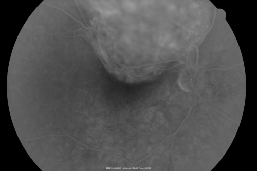 Choroidal Melanoma Medium
33-year-old man with a history of decreased in the right eye.  He had blurring in the eye about a year ago.  He reports that it improved spontaneously until it was â€œnearly resolvedâ€.  He said he had some persistent distortion, but that over the past couple of weeks he has noticed this dark spot recurring in the right eye, the left eye is unaffected.  He does not have any flashes, floaters or change in his peripheral visual acuity.   20/80 OD, 20/16 OS.  No improvement with pinhole.  IOP: 12 OD, 11 OS.  

POSTERIOR SEGMENT EXAMINATION: Shows a clear view with no PVD in either eye.  C/D ratio is 0.2 OU.  Large retinal vessels are unremarkable.  The macula of the right eye has a brown choroidal lesion with pigment overlying the surface and orange spots along its lateral surface.  The left macula is normal.  
B-SCAN:  B-scan ecography of the ultrasound of the right eye shows a mass about 5 mm high with a moderate to low internal reflectivity on A-scan echogram.  There is serous fluid inferiorly on the echogram
