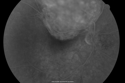Choroidal Melanoma Medium
33-year-old man with a history of decreased in the right eye.  He had blurring in the eye about a year ago.  He reports that it improved spontaneously until it was â€œnearly resolvedâ€.  He said he had some persistent distortion, but that over the past couple of weeks he has noticed this dark spot recurring in the right eye, the left eye is unaffected.  He does not have any flashes, floaters or change in his peripheral visual acuity.   20/80 OD, 20/16 OS.  No improvement with pinhole.  IOP: 12 OD, 11 OS.  

POSTERIOR SEGMENT EXAMINATION: Shows a clear view with no PVD in either eye.  C/D ratio is 0.2 OU.  Large retinal vessels are unremarkable.  The macula of the right eye has a brown choroidal lesion with pigment overlying the surface and orange spots along its lateral surface.  The left macula is normal.  
B-SCAN:  B-scan ecography of the ultrasound of the right eye shows a mass about 5 mm high with a moderate to low internal reflectivity on A-scan echogram.  There is serous fluid inferiorly on the echogram
