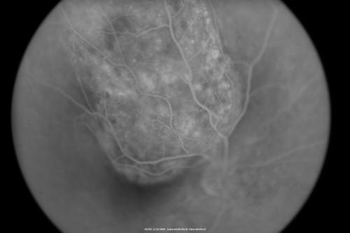 Choroidal Melanoma Medium
33-year-old man with a history of decreased in the right eye.  He had blurring in the eye about a year ago.  He reports that it improved spontaneously until it was â€œnearly resolvedâ€.  He said he had some persistent distortion, but that over the past couple of weeks he has noticed this dark spot recurring in the right eye, the left eye is unaffected.  He does not have any flashes, floaters or change in his peripheral visual acuity.   20/80 OD, 20/16 OS.  No improvement with pinhole.  IOP: 12 OD, 11 OS.  

POSTERIOR SEGMENT EXAMINATION: Shows a clear view with no PVD in either eye.  C/D ratio is 0.2 OU.  Large retinal vessels are unremarkable.  The macula of the right eye has a brown choroidal lesion with pigment overlying the surface and orange spots along its lateral surface.  The left macula is normal.  
B-SCAN:  B-scan ecography of the ultrasound of the right eye shows a mass about 5 mm high with a moderate to low internal reflectivity on A-scan echogram.  There is serous fluid inferiorly on the echogram
