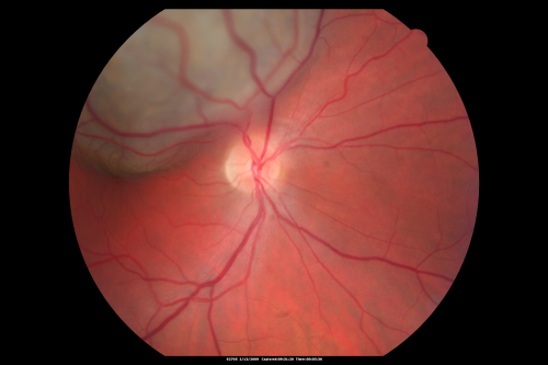 Choroidal Melanoma Medium
33-year-old man with a history of decreased in the right eye.  He had blurring in the eye about a year ago.  He reports that it improved spontaneously until it was â€œnearly resolvedâ€.  He said he had some persistent distortion, but that over the past couple of weeks he has noticed this dark spot recurring in the right eye, the left eye is unaffected.  He does not have any flashes, floaters or change in his peripheral visual acuity.   20/80 OD, 20/16 OS.  No improvement with pinhole.  IOP: 12 OD, 11 OS.  

POSTERIOR SEGMENT EXAMINATION: Shows a clear view with no PVD in either eye.  C/D ratio is 0.2 OU.  Large retinal vessels are unremarkable.  The macula of the right eye has a brown choroidal lesion with pigment overlying the surface and orange spots along its lateral surface.  The left macula is normal.  
B-SCAN:  B-scan ecography of the ultrasound of the right eye shows a mass about 5 mm high with a moderate to low internal reflectivity on A-scan echogram.  There is serous fluid inferiorly on the echogram
