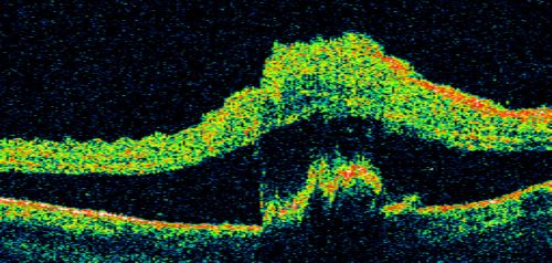 Choroidal Melanoma Medium
33-year-old man with a history of decreased in the right eye.  He had blurring in the eye about a year ago.  He reports that it improved spontaneously until it was â€œnearly resolvedâ€.  He said he had some persistent distortion, but that over the past couple of weeks he has noticed this dark spot recurring in the right eye, the left eye is unaffected.  He does not have any flashes, floaters or change in his peripheral visual acuity.   20/80 OD, 20/16 OS.  No improvement with pinhole.  IOP: 12 OD, 11 OS.  

POSTERIOR SEGMENT EXAMINATION: Shows a clear view with no PVD in either eye.  C/D ratio is 0.2 OU.  Large retinal vessels are unremarkable.  The macula of the right eye has a brown choroidal lesion with pigment overlying the surface and orange spots along its lateral surface.  The left macula is normal.  
B-SCAN:  B-scan ecography of the ultrasound of the right eye shows a mass about 5 mm high with a moderate to low internal reflectivity on A-scan echogram.  There is serous fluid inferiorly on the echogram
