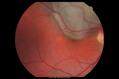 Choroidal Melanoma Medium
33-year-old man with a history of decreased in the right eye.  He had blurring in the eye about a year ago.  He reports that it improved spontaneously until it was â€œnearly resolvedâ€.  He said he had some persistent distortion, but that over the past couple of weeks he has noticed this dark spot recurring in the right eye, the left eye is unaffected.  He does not have any flashes, floaters or change in his peripheral visual acuity.   20/80 OD, 20/16 OS.  No improvement with pinhole.  IOP: 12 OD, 11 OS.  

POSTERIOR SEGMENT EXAMINATION: Shows a clear view with no PVD in either eye.  C/D ratio is 0.2 OU.  Large retinal vessels are unremarkable.  The macula of the right eye has a brown choroidal lesion with pigment overlying the surface and orange spots along its lateral surface.  The left macula is normal.  
B-SCAN:  B-scan ecography of the ultrasound of the right eye shows a mass about 5 mm high with a moderate to low internal reflectivity on A-scan echogram.  There is serous fluid inferiorly on the echogram
