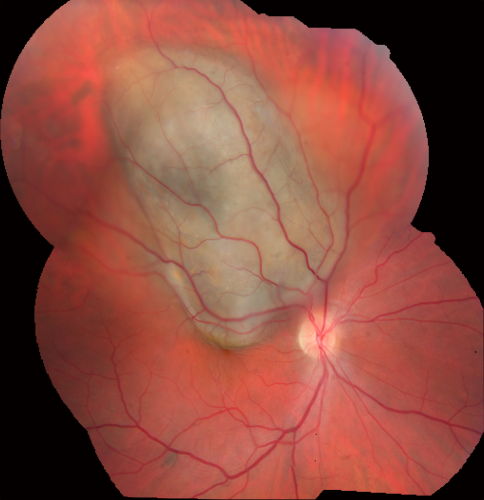 Choroidal Melanoma Medium
33-year-old man with a history of decreased in the right eye.  He had blurring in the eye about a year ago.  He reports that it improved spontaneously until it was â€œnearly resolvedâ€.  He said he had some persistent distortion, but that over the past couple of weeks he has noticed this dark spot recurring in the right eye, the left eye is unaffected.  He does not have any flashes, floaters or change in his peripheral visual acuity.   20/80 OD, 20/16 OS.  No improvement with pinhole.  IOP: 12 OD, 11 OS.  

POSTERIOR SEGMENT EXAMINATION: Shows a clear view with no PVD in either eye.  C/D ratio is 0.2 OU.  Large retinal vessels are unremarkable.  The macula of the right eye has a brown choroidal lesion with pigment overlying the surface and orange spots along its lateral surface.  The left macula is normal.  
B-SCAN:  B-scan ecography of the ultrasound of the right eye shows a mass about 5 mm high with a moderate to low internal reflectivity on A-scan echogram.  There is serous fluid inferiorly on the echogram
