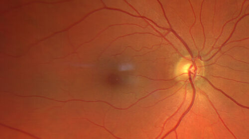 Advanced age-related macular degeneration
87 year old female.  Severe macular bleed 15 years ago OD.  Now with disciform scar.  Left eye has progressing geographic atrophy.
VA OD: HM,  OS: 5/200.  IOP normal OU

