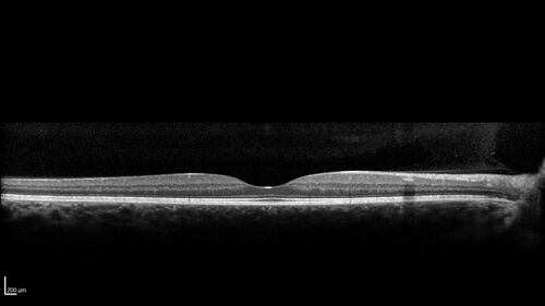 Advanced age-related macular degeneration
87 year old female.  Severe macular bleed 15 years ago OD.  Now with disciform scar.  Left eye has progressing geographic atrophy.
VA OD: HM,  OS: 5/200.  IOP normal OU
