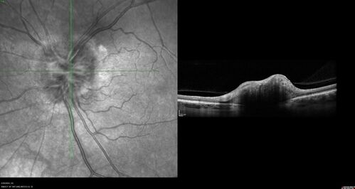 Advanced age-related macular degeneration
87 year old female.  Severe macular bleed 15 years ago OD.  Now with disciform scar.  Left eye has progressing geographic atrophy.
VA OD: HM,  OS: 5/200.  IOP normal OU
