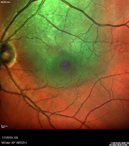 Atypical High Risk Choroidal Nevus vs Macular Melanoma
70 year old female with vision loss in the left eye for a few weeks.  She was referred to a tumor center and being managed as an 