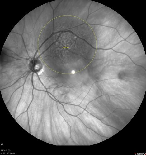 Atypical High Risk Choroidal Nevus vs Macular Melanoma
70 year old female with vision loss in the left eye for a few weeks.  She was referred to a tumor center and being managed as an 