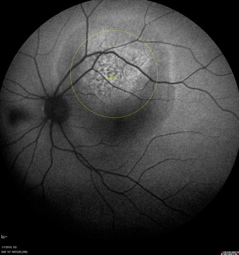 Atypical High Risk Choroidal Nevus vs Macular Melanoma
70 year old female with vision loss in the left eye for a few weeks.  She was referred to a tumor center and being managed as an 