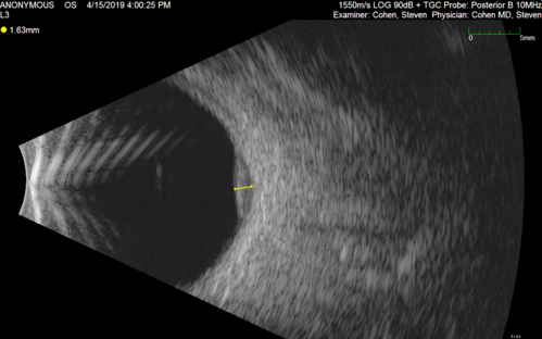 Atypical High Risk Choroidal Nevus vs Macular Melanoma
70 year old female with vision loss in the left eye for a few weeks.  She was referred to a tumor center and being managed as an 