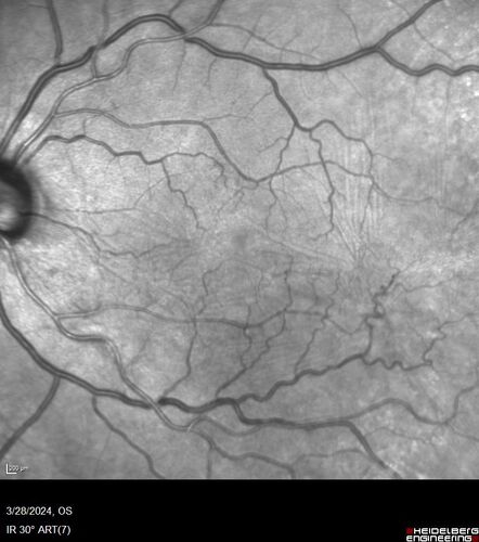 Serous Macular Detachment from Small Choroidal Melanoma
72 year old female misdiagnosed as CSR who had small choroidal melanoms.

