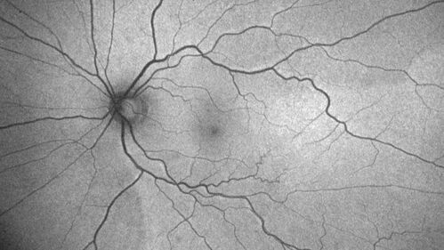 Serous Macular Detachment from Small Choroidal Melanoma
72 year old female misdiagnosed as CSR who had small choroidal melanoms.
